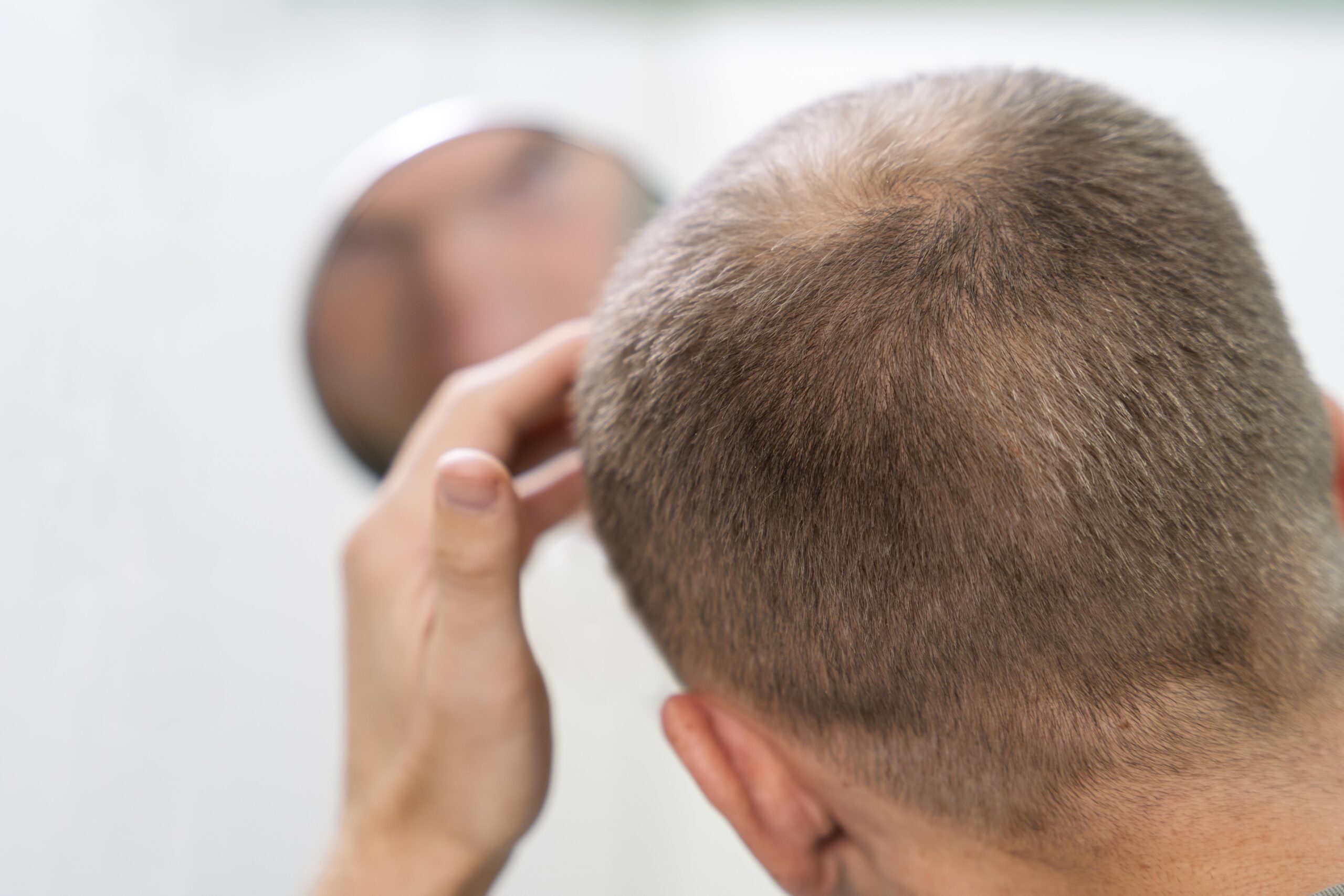 Hairfall